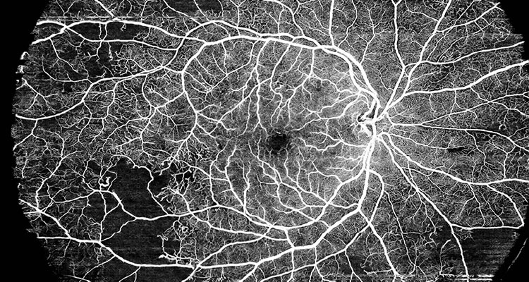 diabetic retinopathy