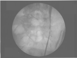 Pre-operative cystoscopy image