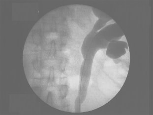 Pre-operative cystoscopy image showing evidence of hydroureteronephrosis