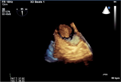 Echocardiography showing the location of the tumor thrombus