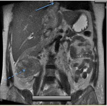 Magnetic resonance imaging at 31 weeks gestation showing a mass