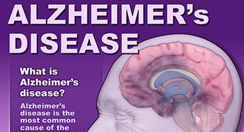alzheimers disease infographic