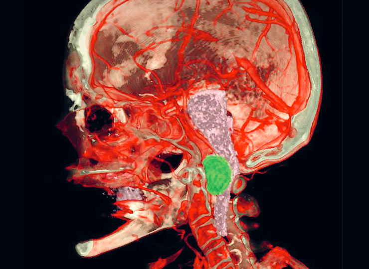 image of MRI scan of human skull and neck
