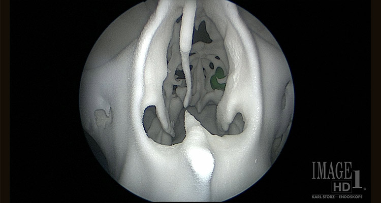 View through an endoscope of multi-component 3D print during pre-operative planning and rehearsal for a transnasal tumor resection.
