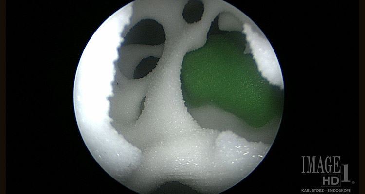 View through an endoscope of multi-component 3D print during pre-operative planning and rehearsal for a transnasal tumor resection.