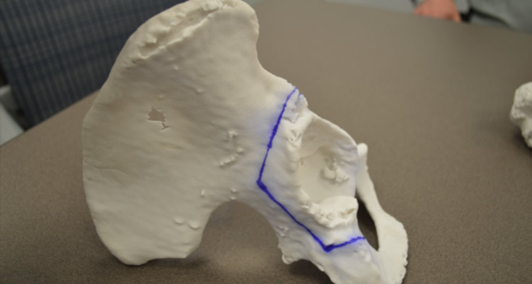 3D print of pelvis component for surgical planning, with blue outline highlighting targets for surgical approach.