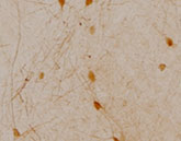 Lewy Neurites that appear in a case of Lewy Body Dementia
