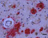 Lab slide of brain matter displaying age-related cognitive decline