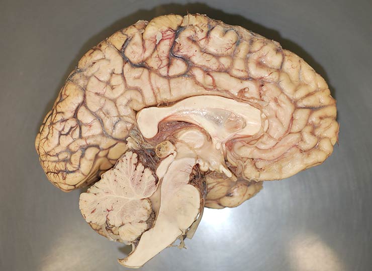 Biopsy of a brain