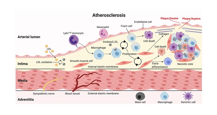 Atherosclerosis graphic