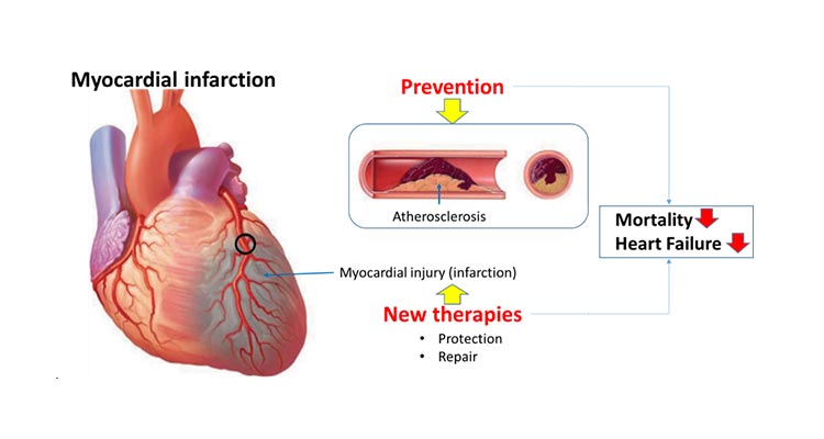 Myocardial Infarction Icahn School Of Medicine