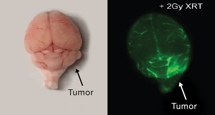 side-by-side of brain tumor versus scan
