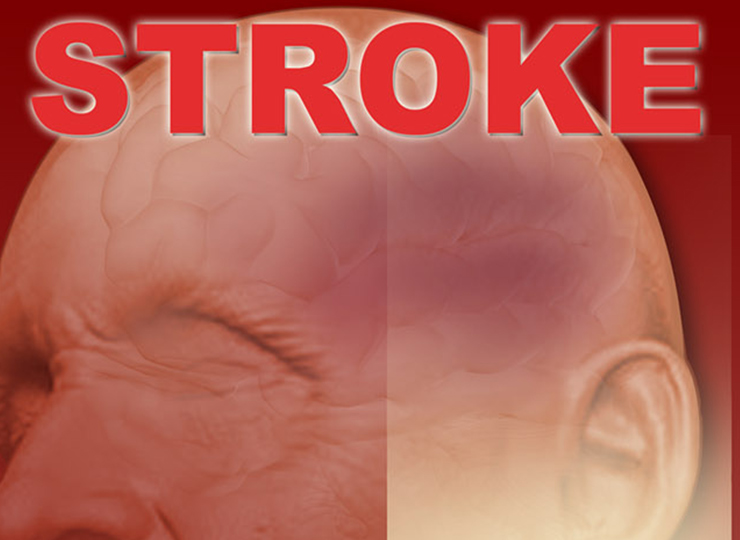 Get the Facts on Stroke